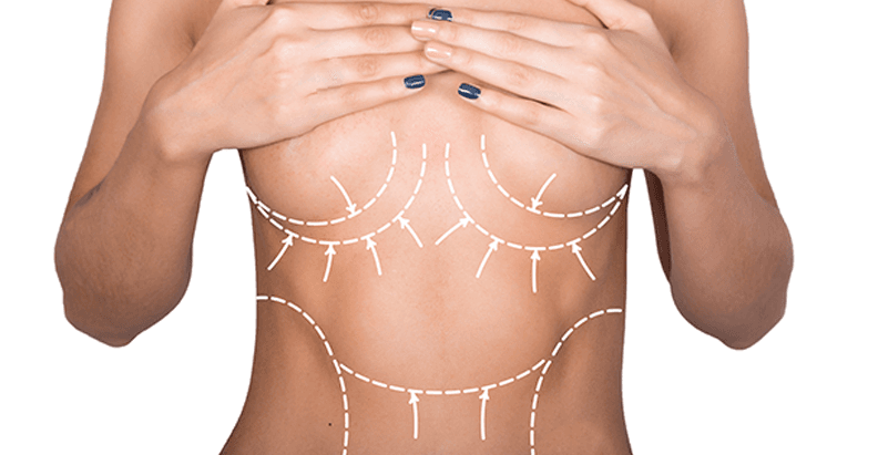 Body sculpting consultation markings